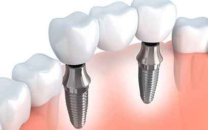 dental implants
